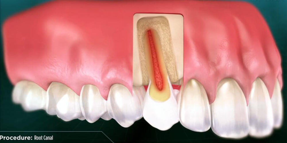 endodontics-content-image